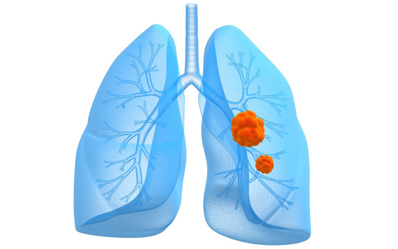 lung cancer award.jpg